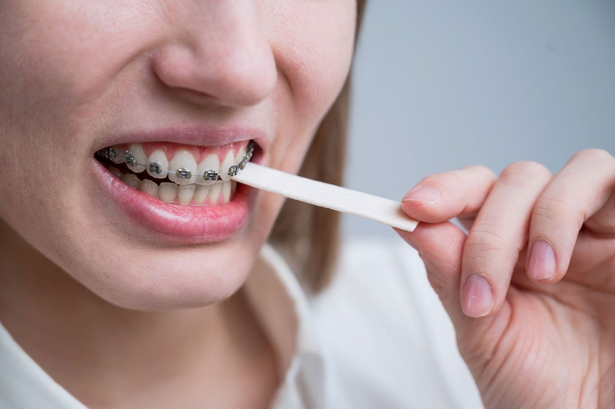 Gourmandises : déguster sans nuire à son traitement orthodontique