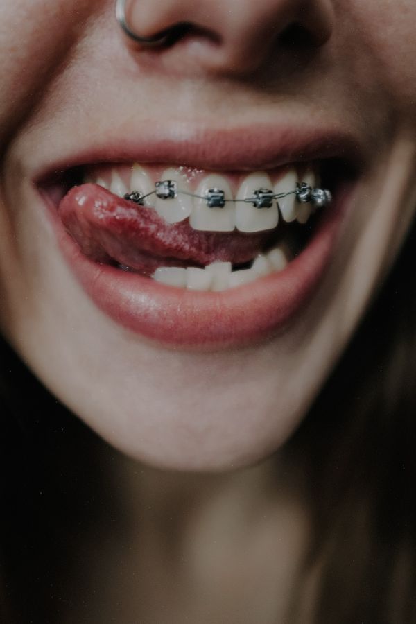 Le traitement orthodontique peut-il causer une perte osseuse?