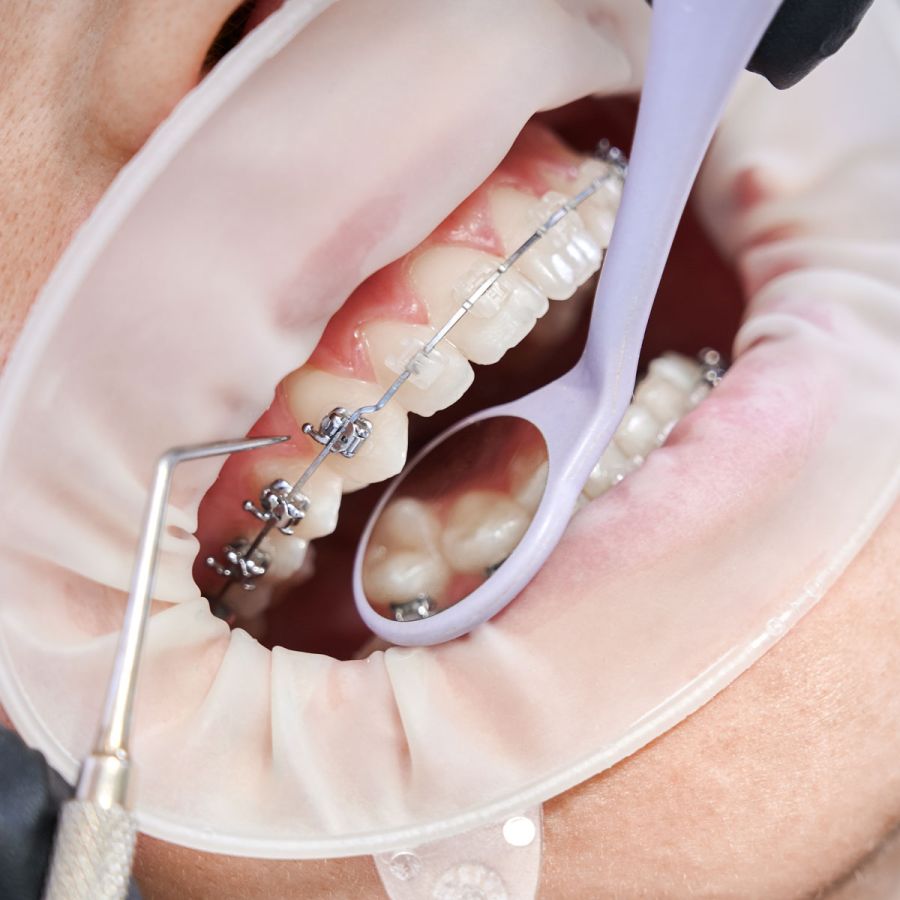 Est-ce que tous les traitements orthodontiques sont couverts par les assurances?