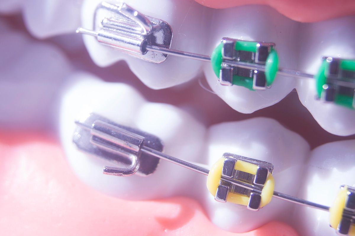 Comment savoir quand les broches sont nécessaires ?