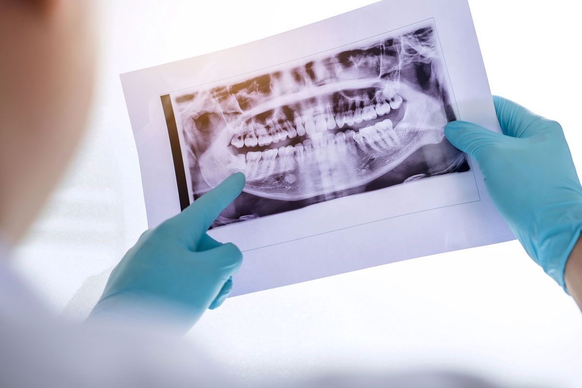 Quels sont les signes indiquant que la chirurgie maxillo-faciale devrait compléter votre traitement orthodontique ?
