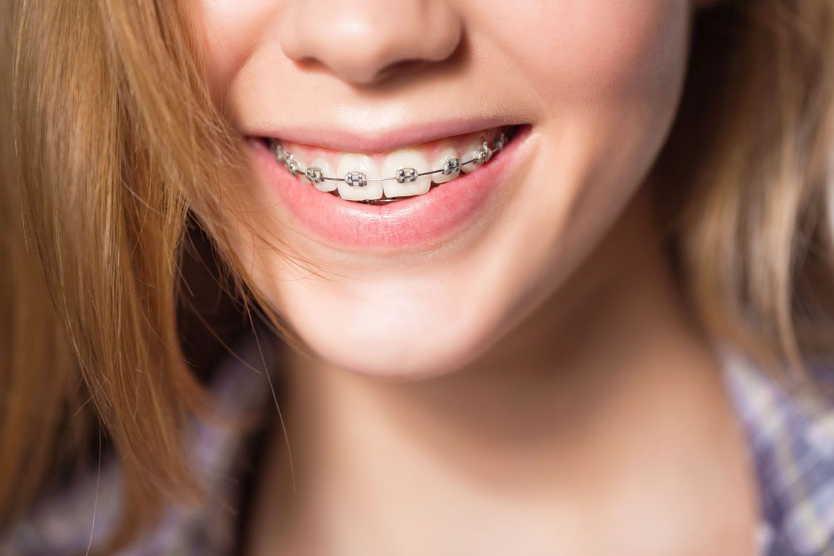 L’âge idéal pour un traitement orthodontique