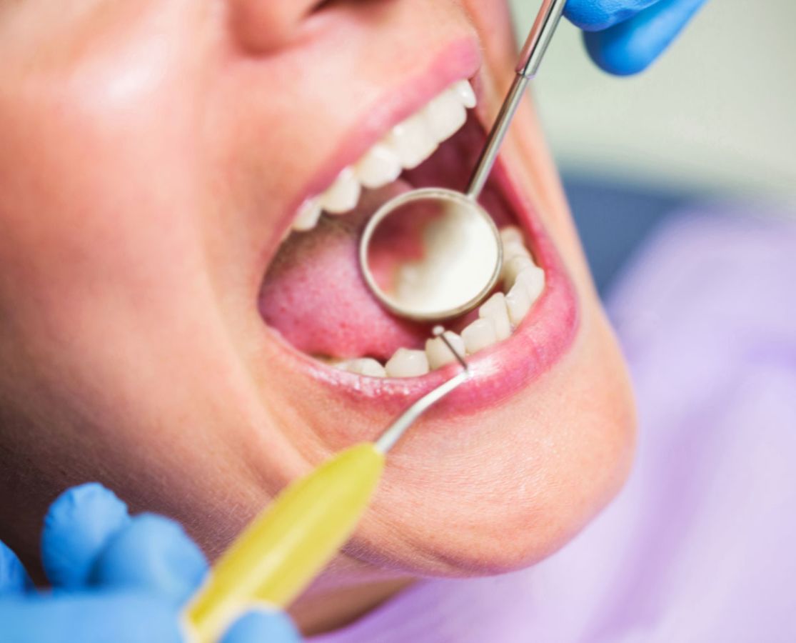 Quel genre d’entretien doit-on faire après un traitement orthodontique?