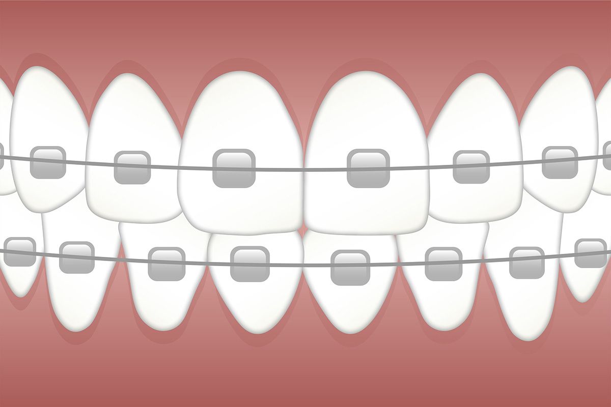 Orthodontie : nécessité ou caprice ?