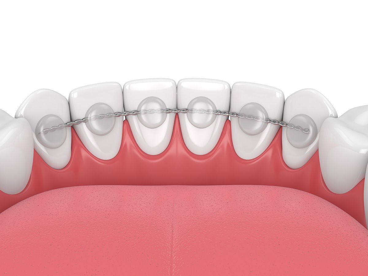 Qu’est-ce que le fil de rétention dans le traitement orthodontique?