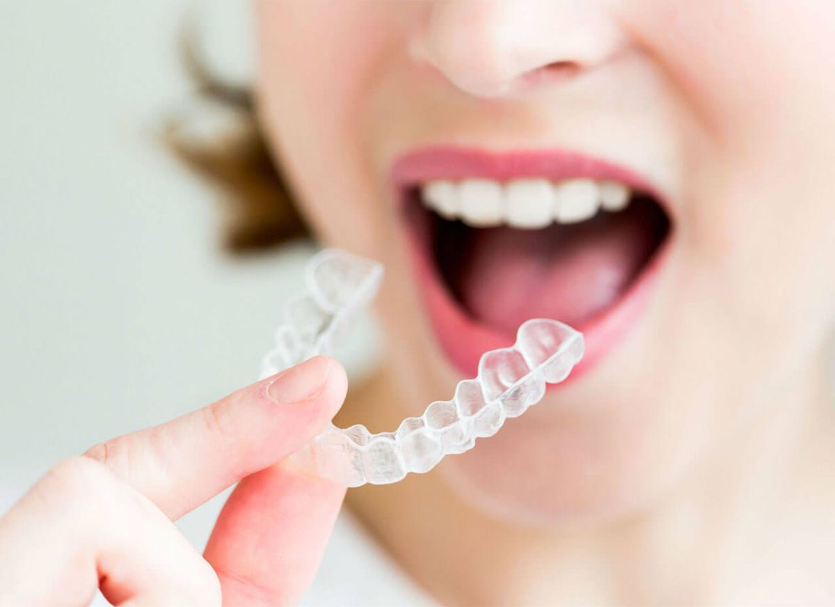 Conseils pour l’entretien de gouttières d’alignement Invisalign
