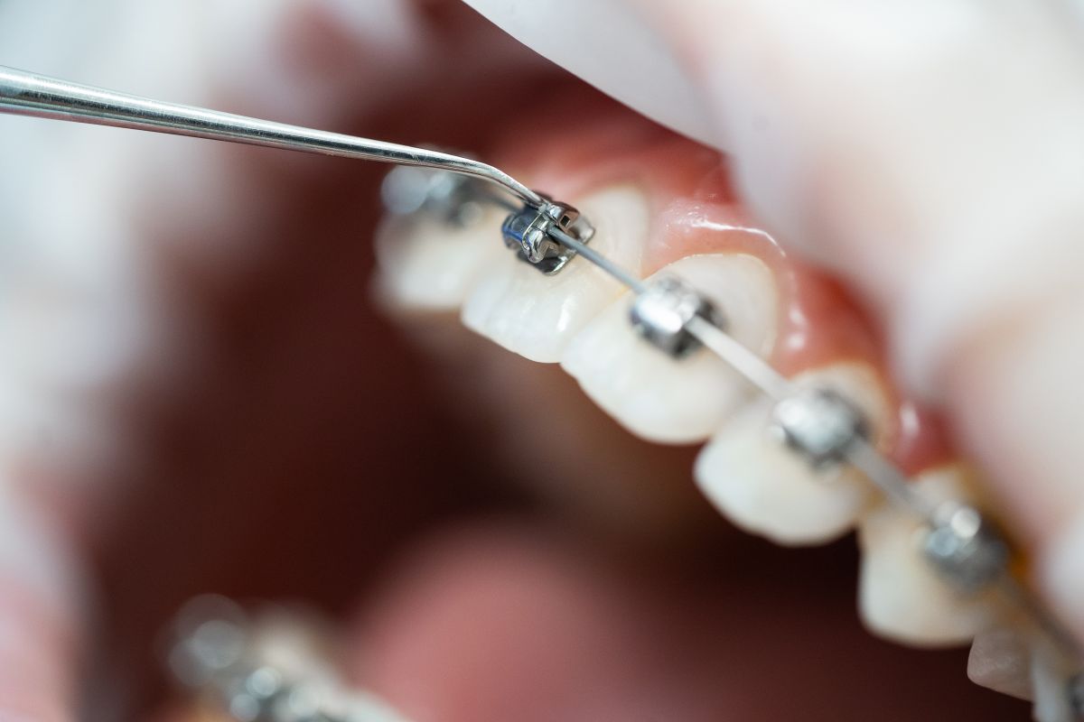 Douleur apr&egrave;s un ajustement orthodontique : quoi faire (et quoi &eacute;viter)