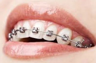 L’hygiène bucco-dentaire en orthodontie