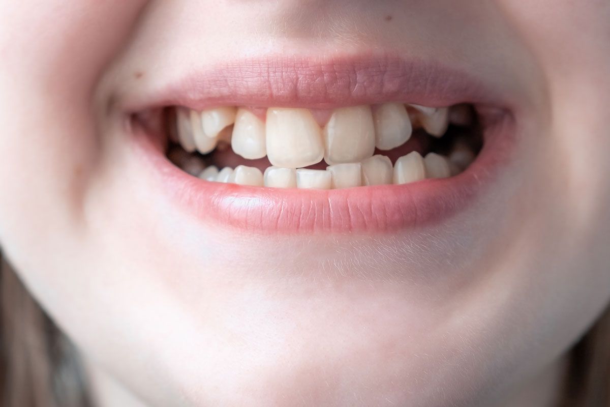Malocclusion dentaire : Définition, risques associés et traitements recommandés