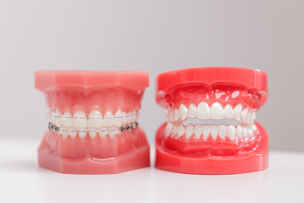 Invisalign ou broches : quel traitement orthodontique choisir ?