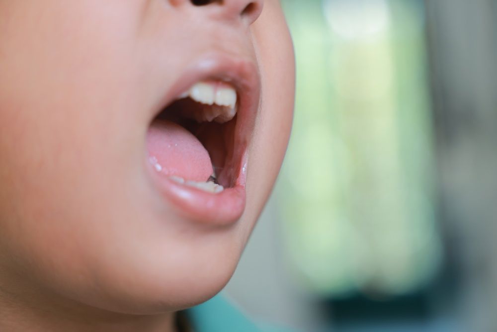 Respiration buccale chez l'enfant : effets sur les dents et la mâchoire